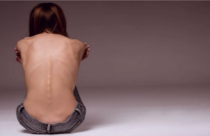 Anoressia 1