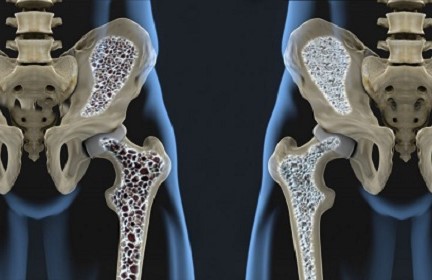 osteoporosi